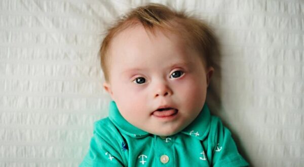 What is Down's Syndrome and It's Causes, Risk Factors & Complications