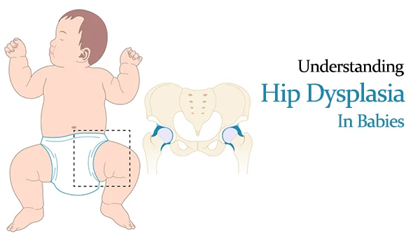 Babies Hip Dysplasia