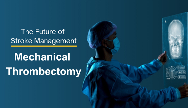 The Future of Stroke Management: Mechanical Thrombectomy