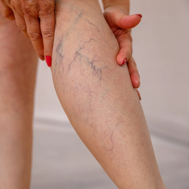 Vericose Veins Treatment